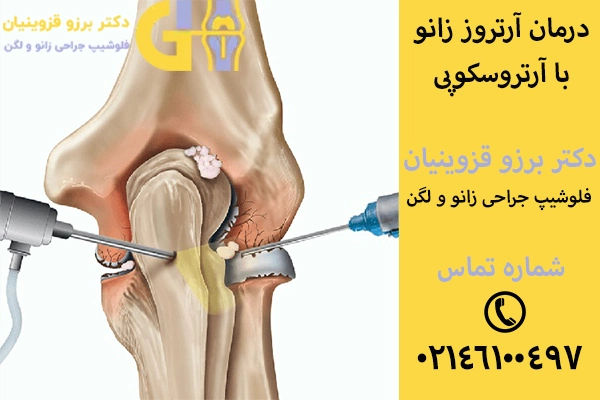 آرتروسکوپی زانو برای درمان آرتروز