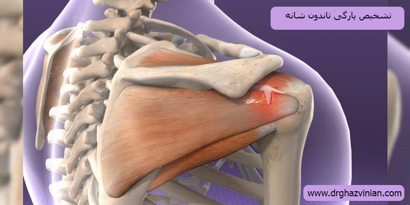تشخیص-پارگی-تاندون-شانه