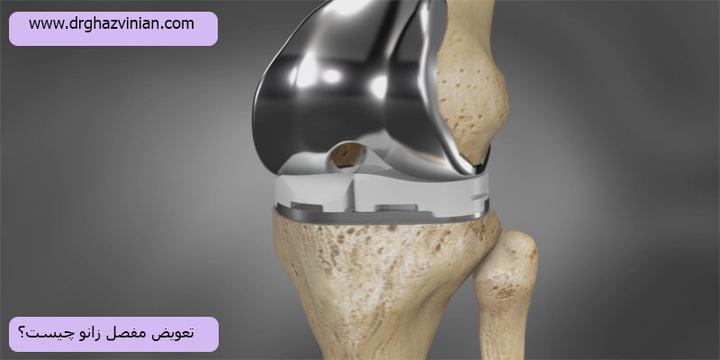 تعویض-مفصل-زانو-چیست؟