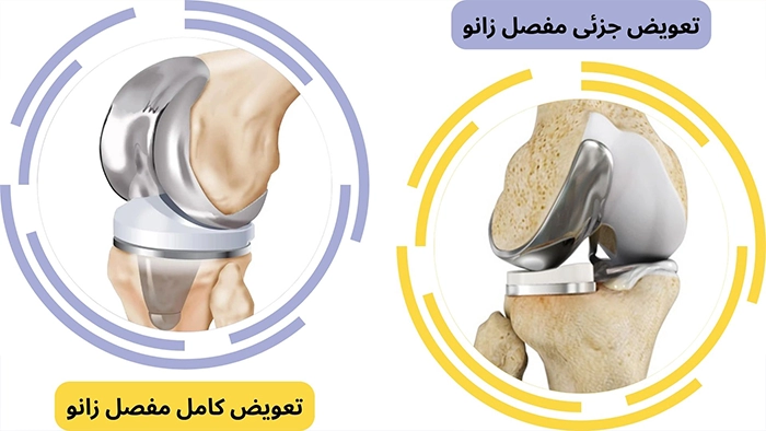انواع تعویض مفصل زانو