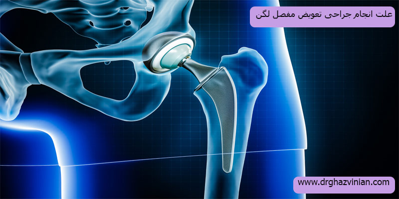 علت-انجام-جراحی-تعویض-مفصل-لگن