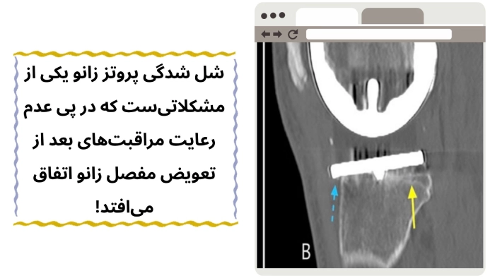 شل شدگی پروتز زانو