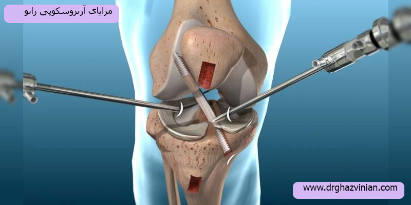 مزایای-آرتروسکوپی-زانو