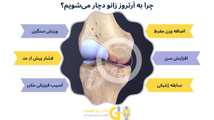 علت آرتروز