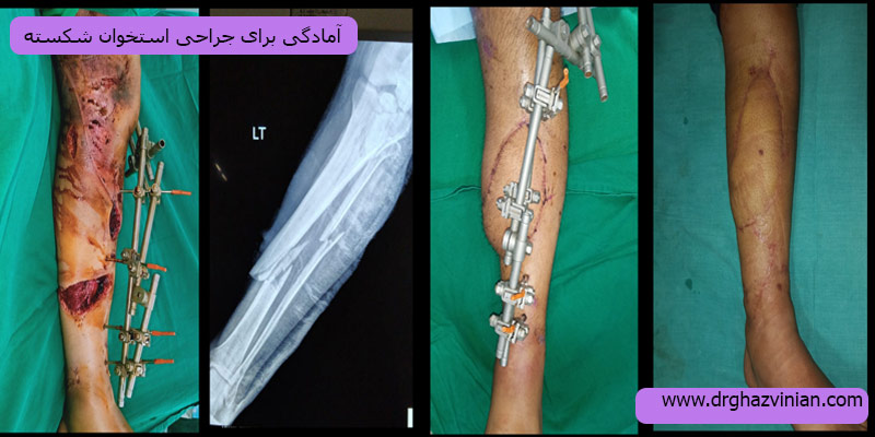 آمادگی-لازم-برای-جراحی-استخوان-شکسته