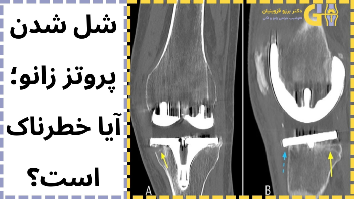 شل شدن پروتز زانو