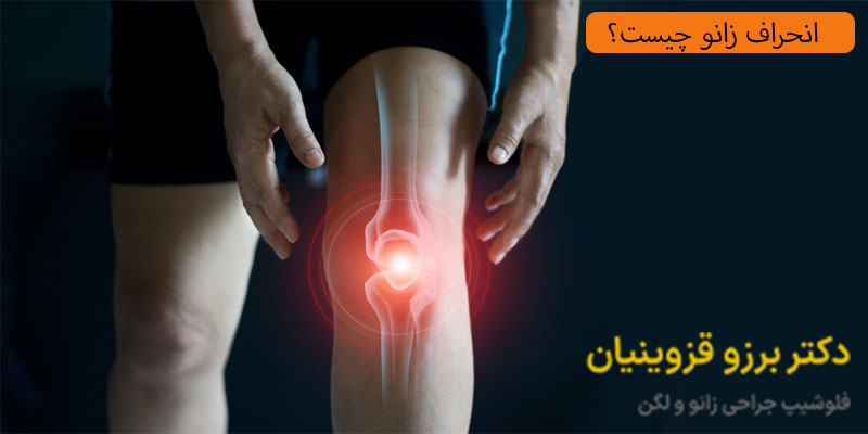 انحراف-زانو-چیست