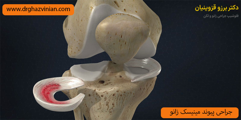 جراحی-پیوند-مینیسک-زانو