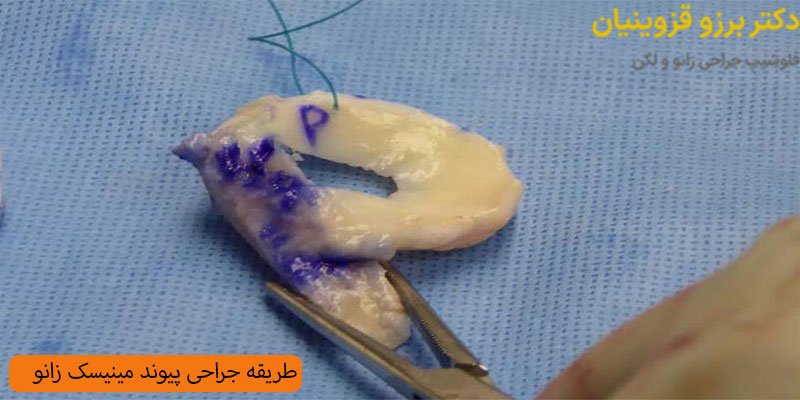 طریقه-جراحی-پیوند-مینیسک-زانو
