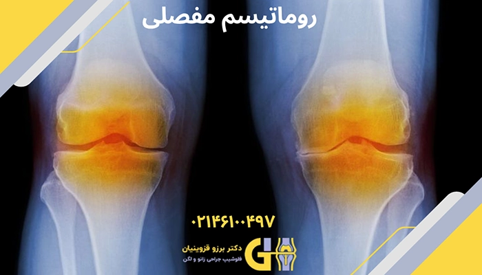 تصویر روماتیسم مفصلی