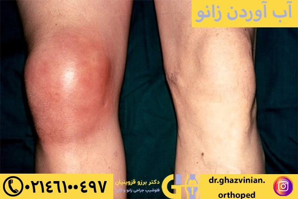 آب آوردن زانو