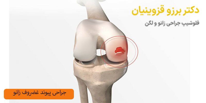 جراحی-پیوند-ضروف-زانو