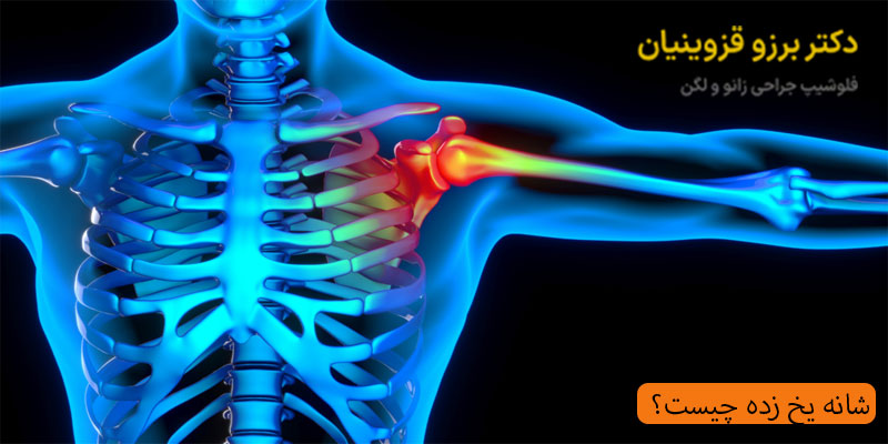 شانه-یخ-زده-چیست