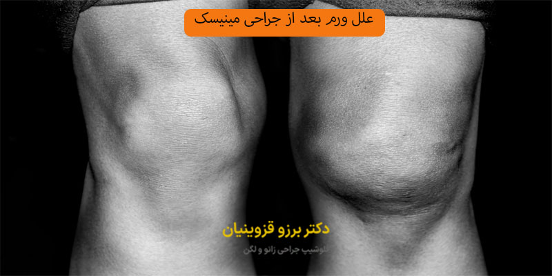 علل ورم بعد از جراحی مینیسک زانو