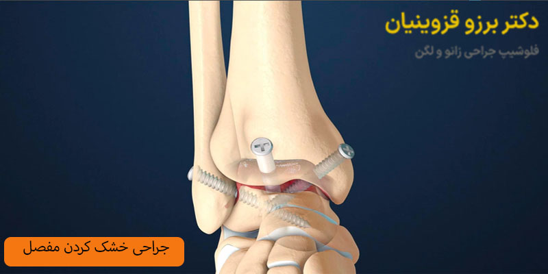 جراحی-خشک-کردن-مفصل