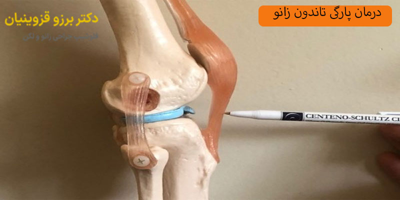 درمان پارگی تاندون زانو