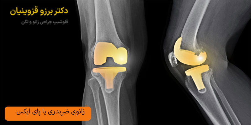 زانوی ضربدری یا پای ایکس چیست؟