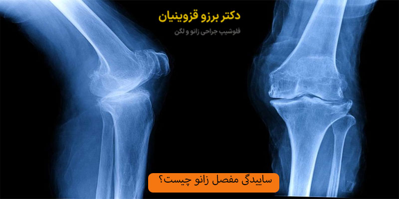 ساییدگی-مفصل-زانو-چیست؟