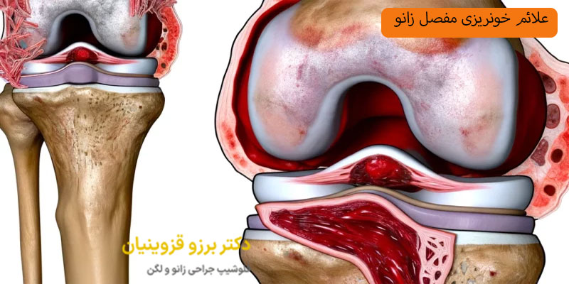 علائم خونریزی مفصل زانو