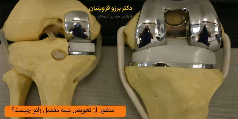 منظور-از-تعویض-نیمه-مفصل-زانو-چیست؟