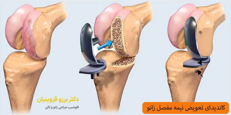 کاندیدای-جراحی-تعویض-نیمه-مفصل-زانو