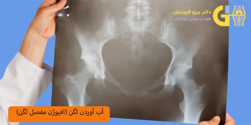 آب-آوردن-لگن-(افیوژن-مفصل-لگن)