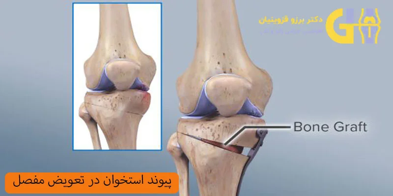 تعویض-مفصل-با-پیوند-استخوان