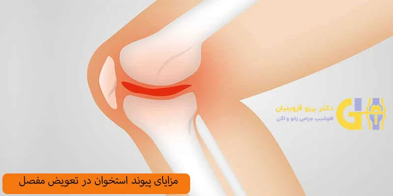 مزایای-پیوند-استخوان-در-جراحی-تعویض-مفصل