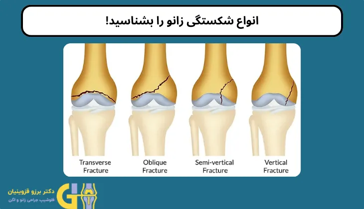 انواع شکستگی زانو