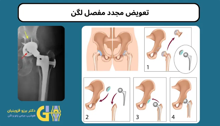 تعویض مفصل لگن