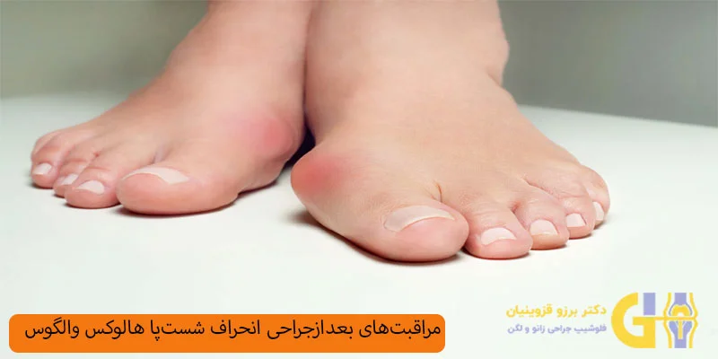 مراقبت-های-بعد-از-جراحی-انحراف-شست-پا