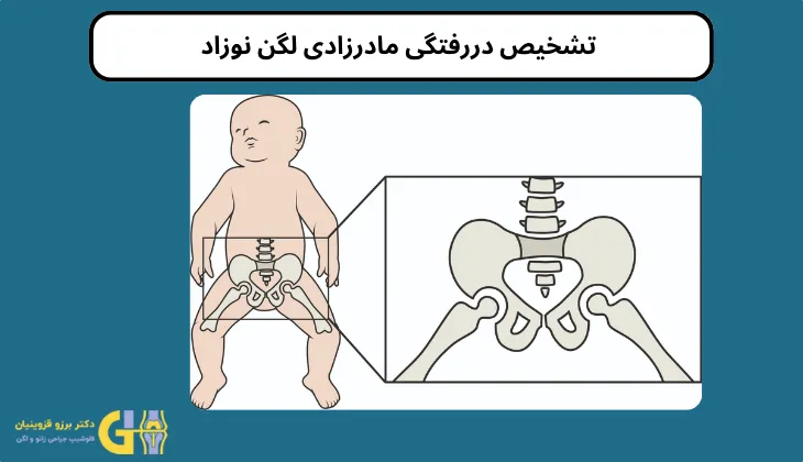  تشخیص دررفتگی مادرزادی لگن نوزاد