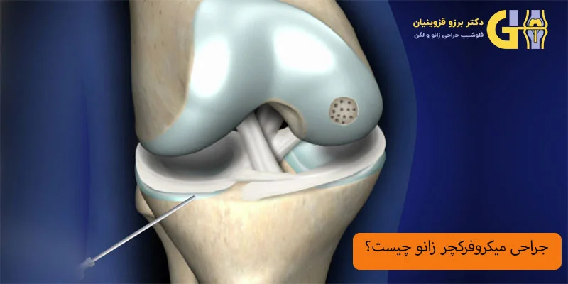جراحی-میکروفرکچر-زانو-چیست؟