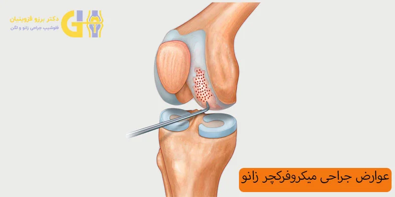 عوارض-جراحی-میکروفرکچر-زانو
