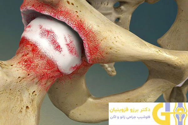 آرتروز لگن و آسیب به مفصل