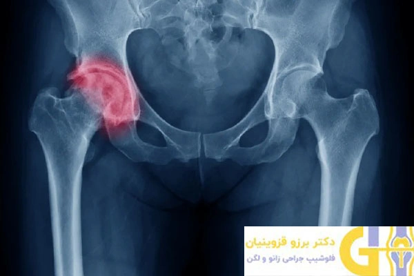 تصویر x-ray آرتریت لگن و ران