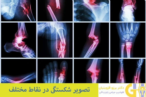 شکستگی در نقاط مختلف بدن