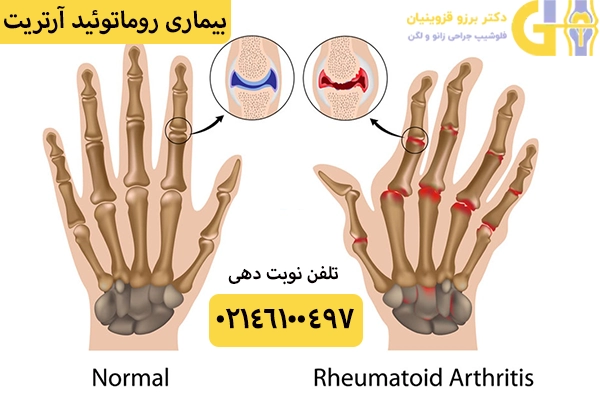 انواع روماتیسم؛ روماتوئید آرتریت