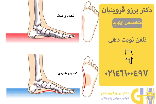 عوارض کف پای صاف