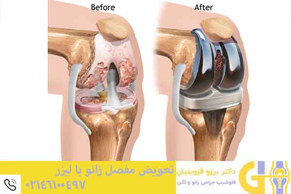 تعویض مفصل زانو با لیزر