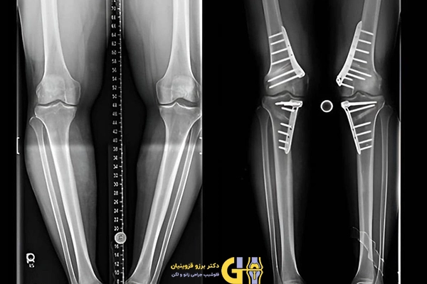 عوارض جراحی پای پرانتزی