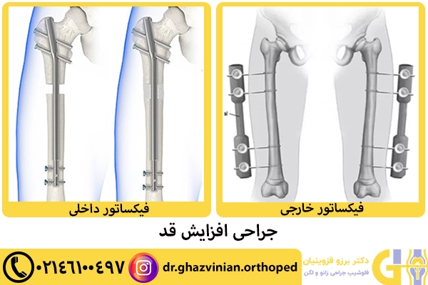 جراحی افزایش قد