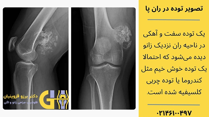 عکس برداری از توده ران پا