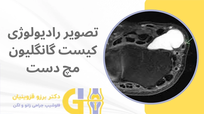 کیست گانگلیون مچ دست