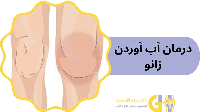 درمان آب آوردن زانو