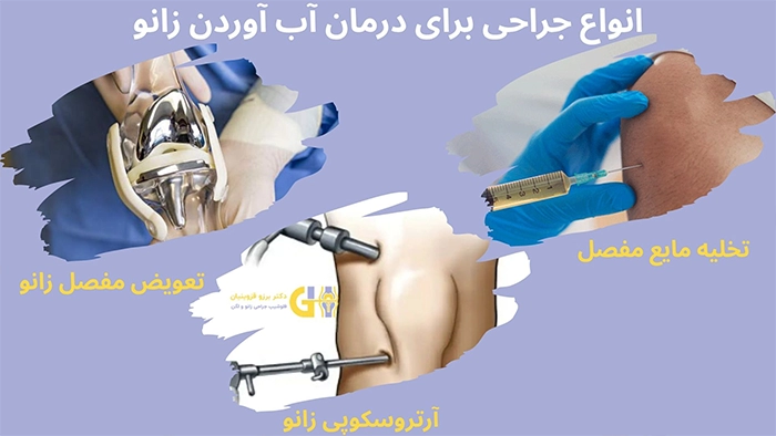 جراحی آب آوردن زانو 