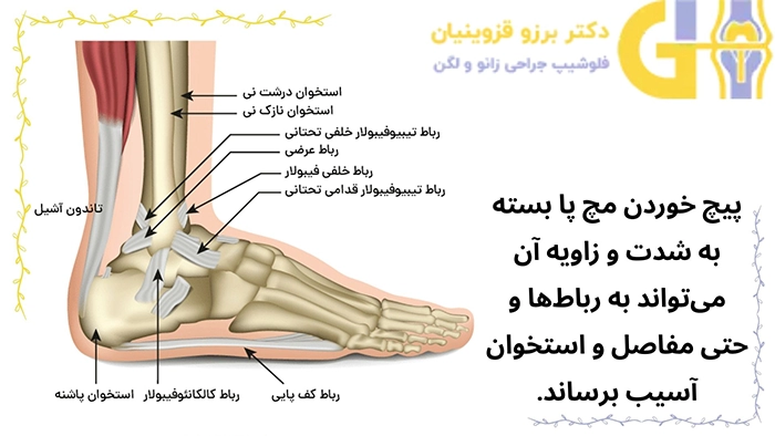 پیچ خوردن مچ پا